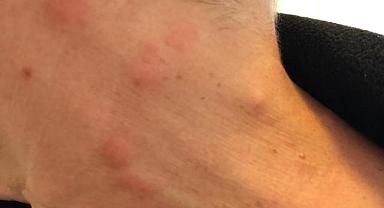 Sakarya Eğitim Araştırma Hastanesi'nde Böcek Kabusu!